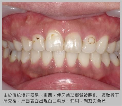 牙齒 鈣化 治療